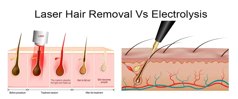 Electrolysis And Laser Hair Removal