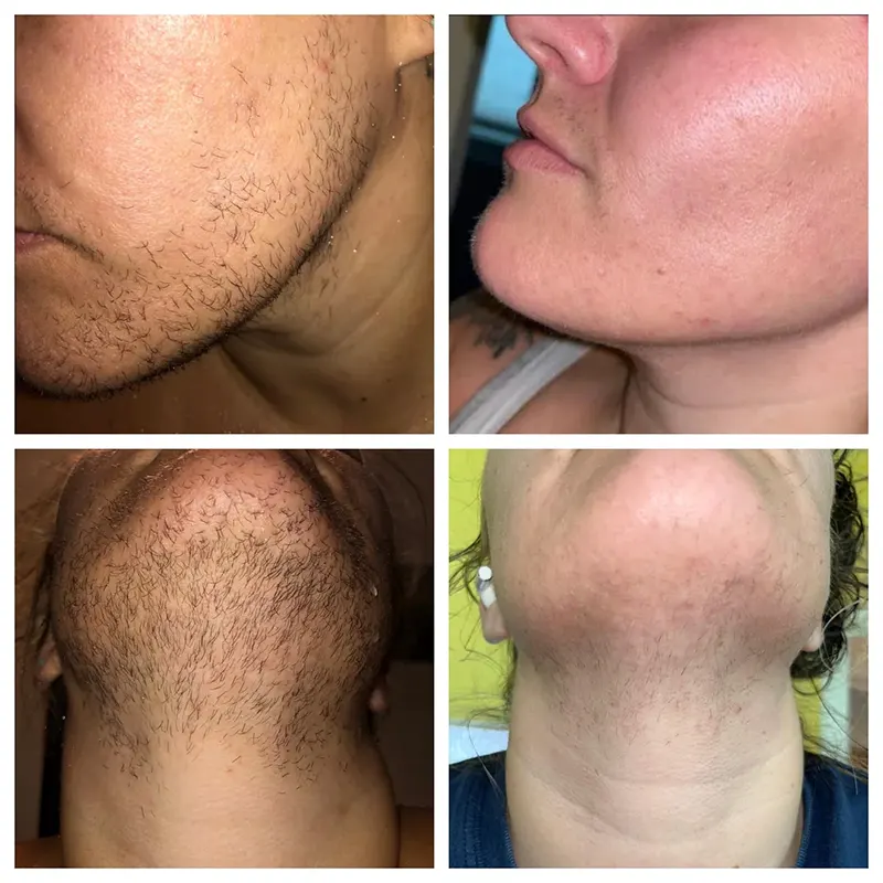 Electrolysis Hair Removal Before After